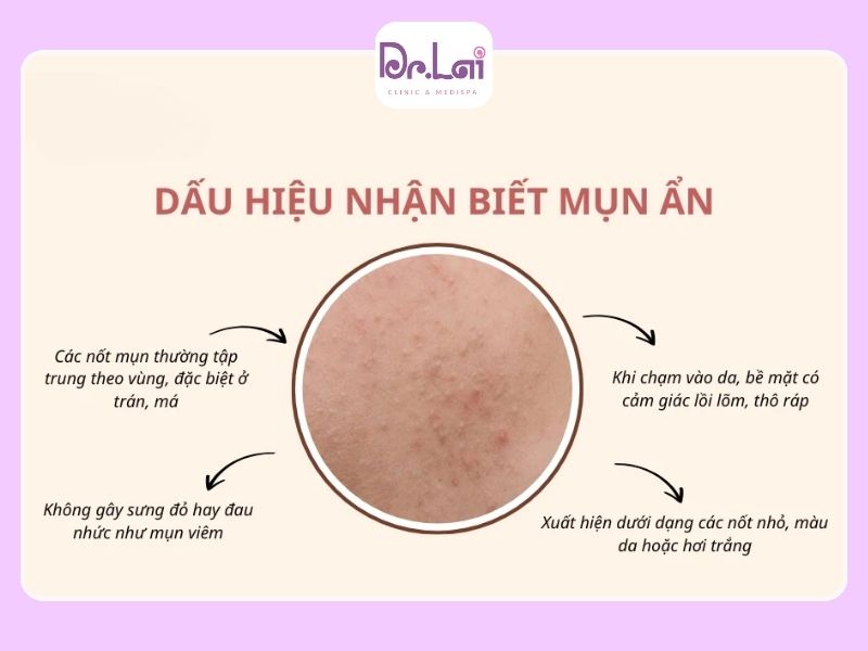 Mụn ẩn là gì và dấu hiệu nhận biết chính xác