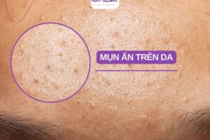 Vì sao mụn ẩn khó hết? Cách trị mụn ẩn đúng cách bạn cần biết