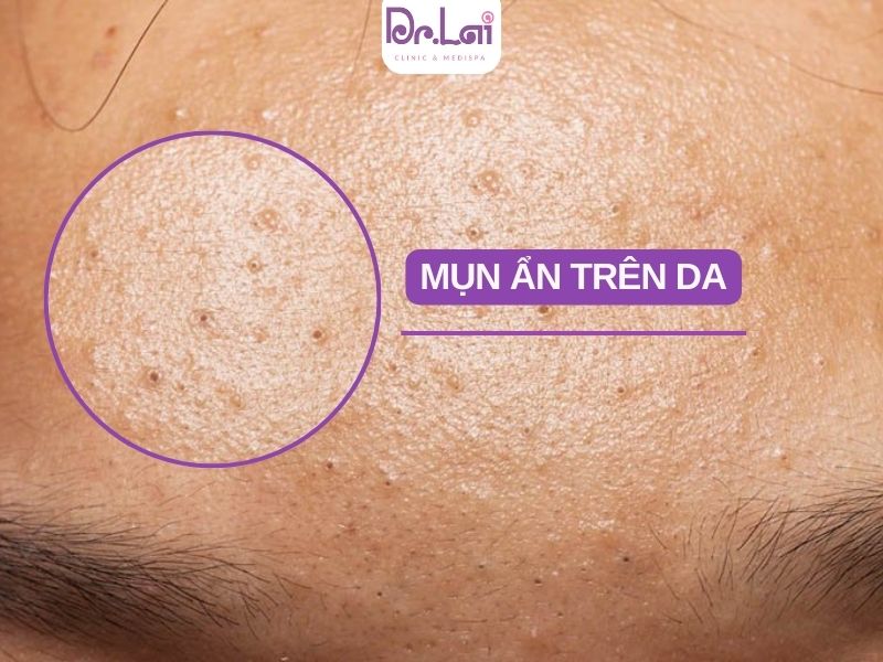 Giải mã: Vì sao mụn ẩn khó hết và thường xuyên tái phát?