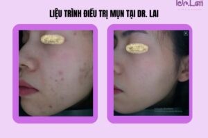 Quy trình trị thâm mụn gồm những bước nào? Giải đáp chi tiết