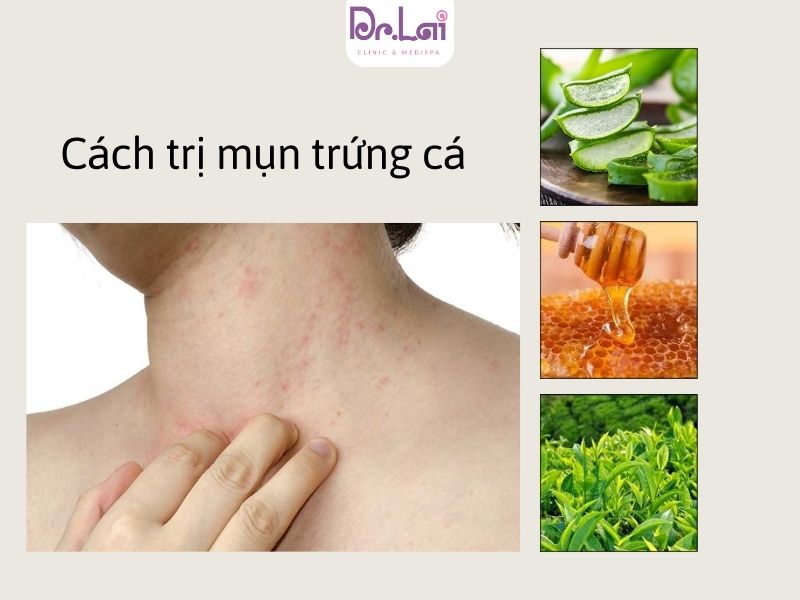 Cách trị mụn trứng cá ở cổ bằng thiên nhiên