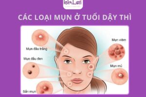 Mụn trứng cá tuổi dậy thì: cách chăm sóc hạn chế thâm sẹo