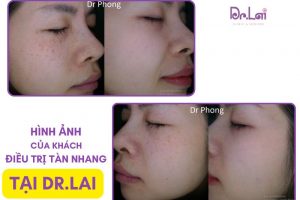 Nám tàn nhang có chữa được không? Những điều cần biết trước khi điều trị