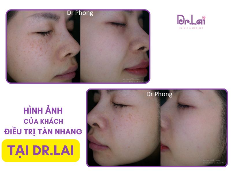 Nám tàn nhang có chữa được không? Những điều cần biết trước khi điều trị