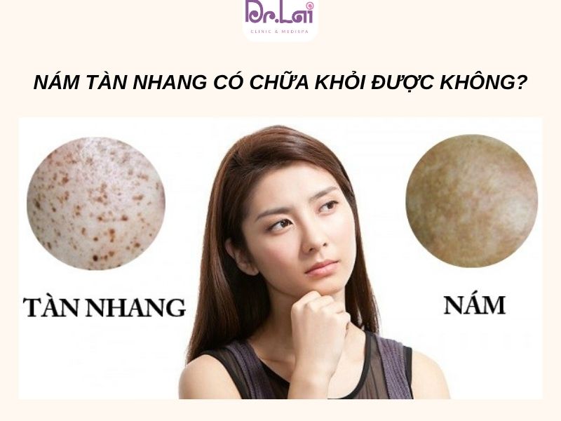 Nám tàn nhang